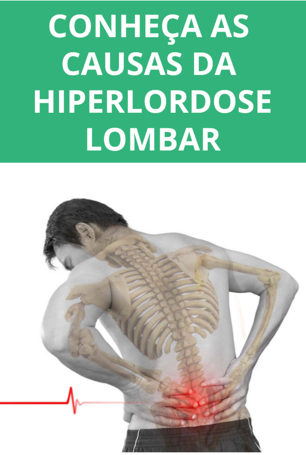 Hiperlordose Lombar: Como a Alignmed Brasil pode Ajudar a Melhorar Sua Postura
