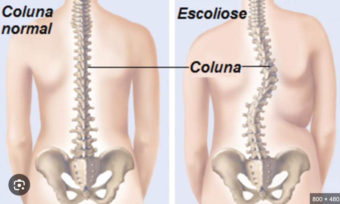 Escoliose e o Uso dos Produtos da Alignmed Brasil