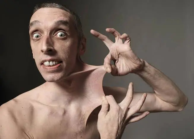 Síndrome de Ehlers Danlos